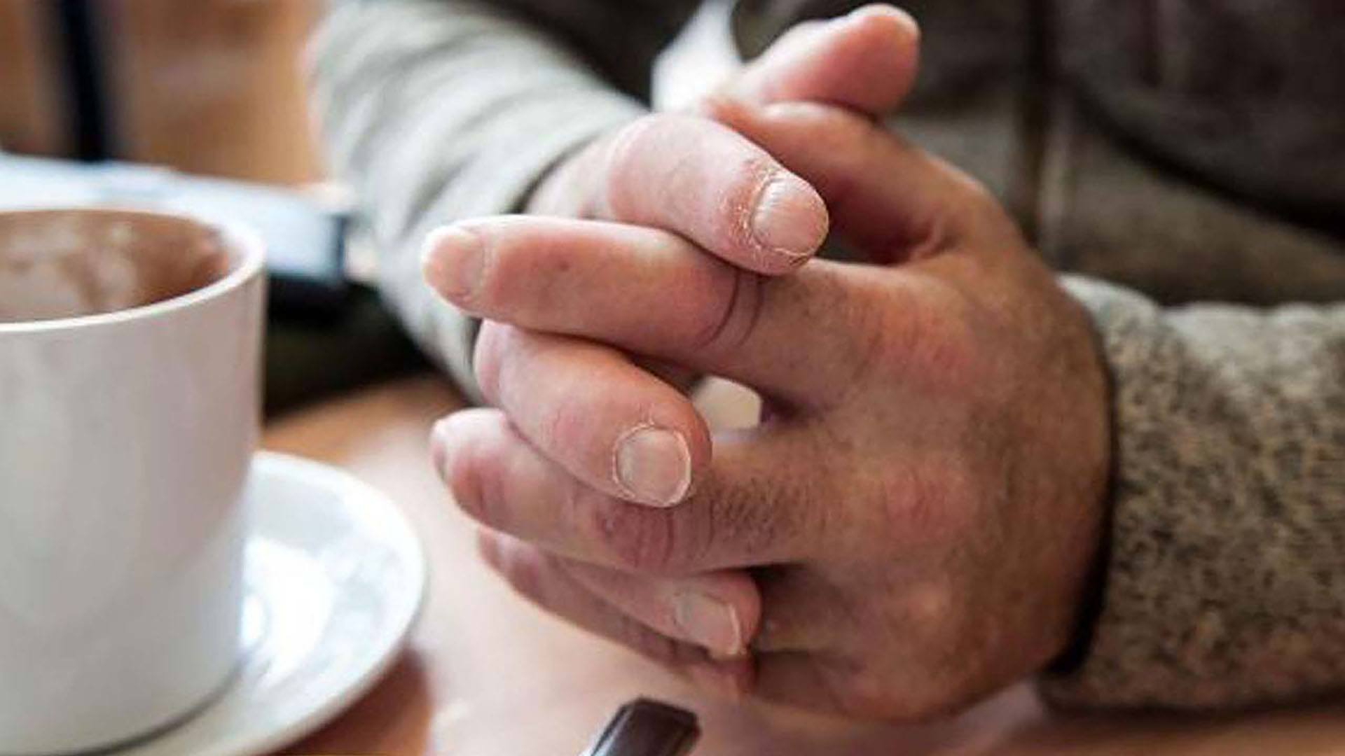 symptoms-hands_puffy_hands_and_fingers