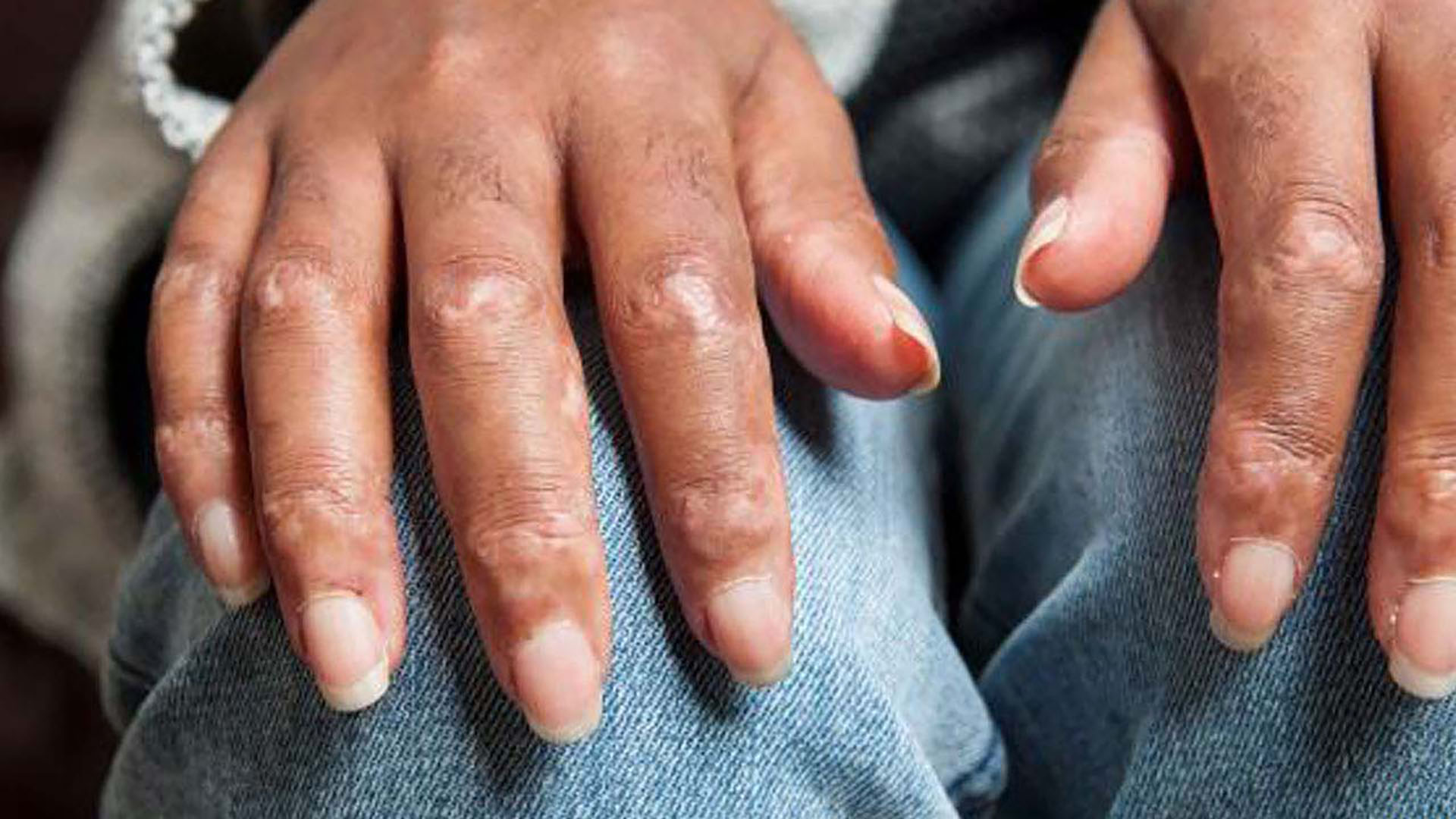 symptoms-hands_skin_tightening_and_thickening_on_the_fingers