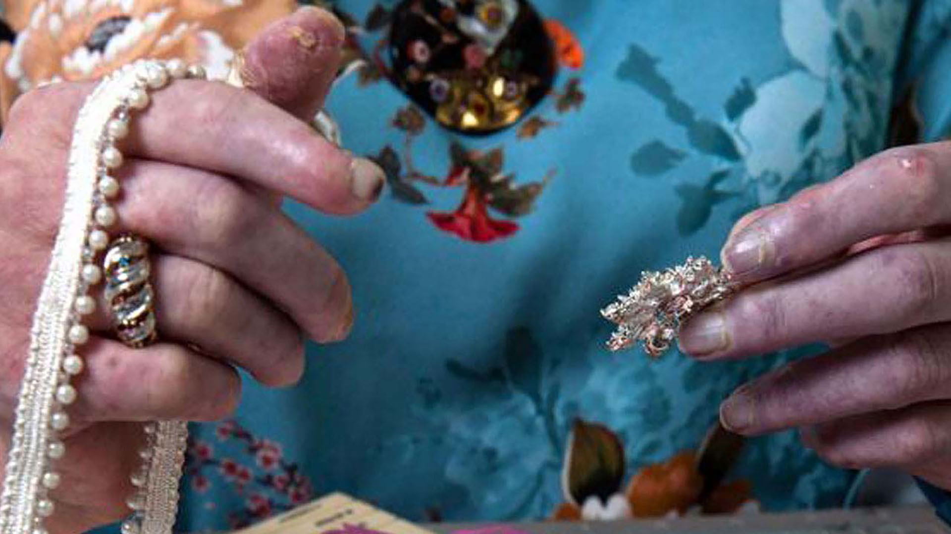 symptoms-hands_ulcers_or_open_sores