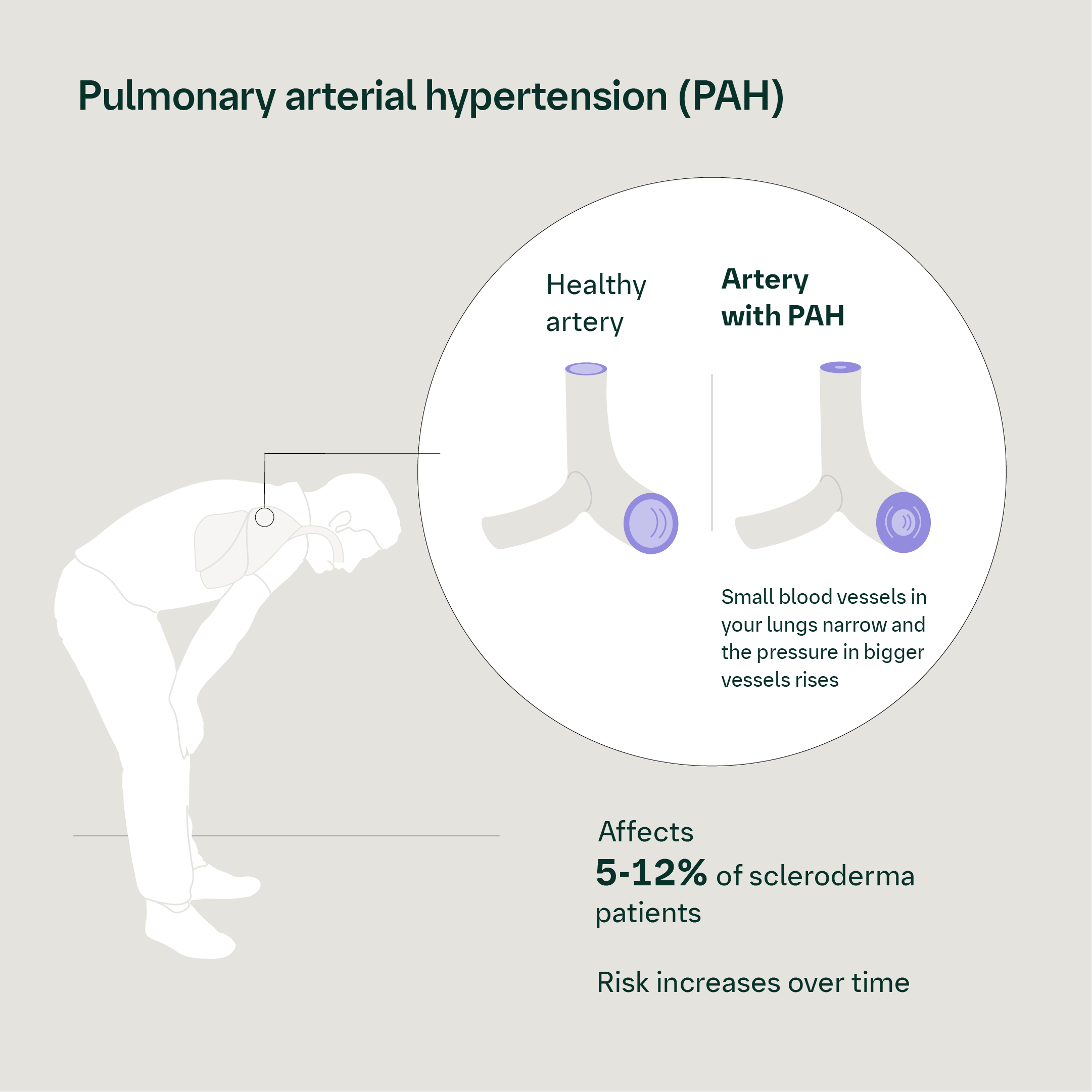 Pulmonary arterial hypertension