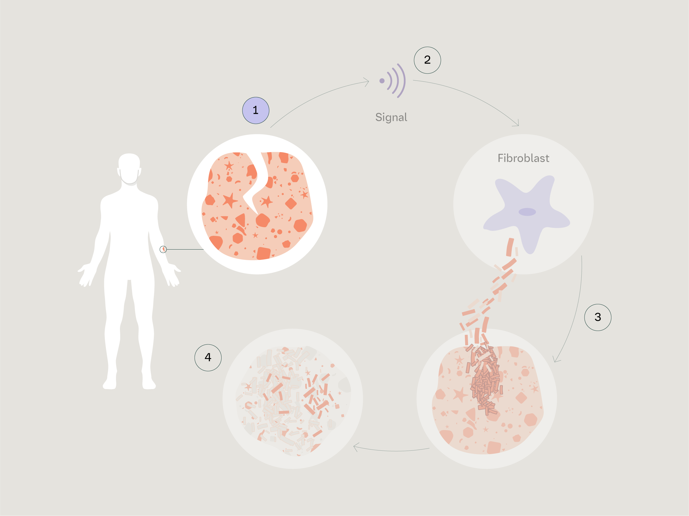 Healing Cycle in Scleroderma 1
